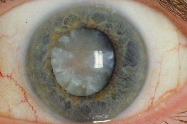 Cataract Surgery (Motiyabind)