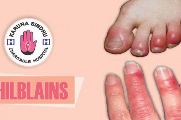 Chilblains | Winter | Painful | Problems | Consult